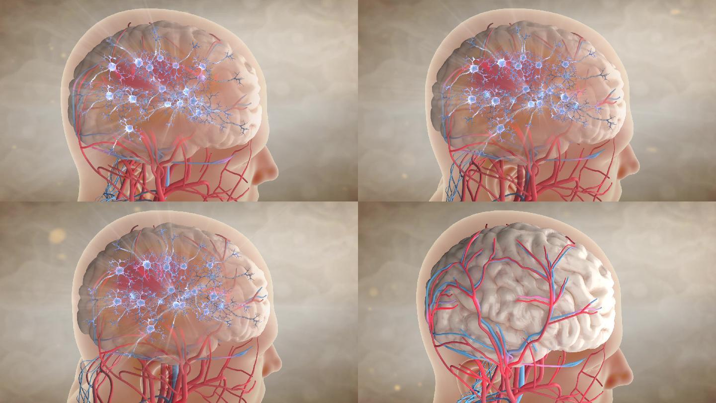 AE分层工程 脑神经 脑供血