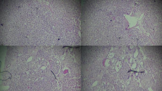 甲状腺腺瘤微观观察细菌
