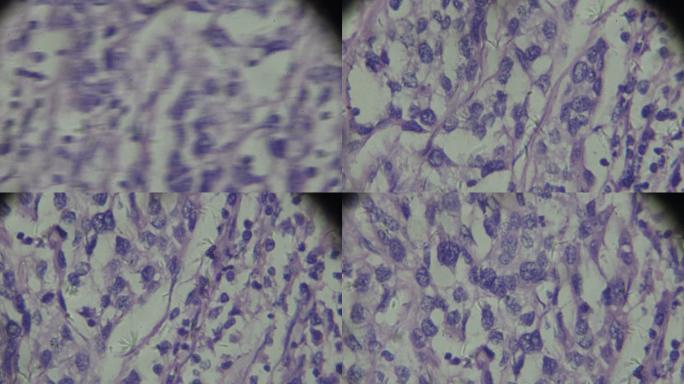 显微镜下膀胱移行细胞癌不同区域的放大