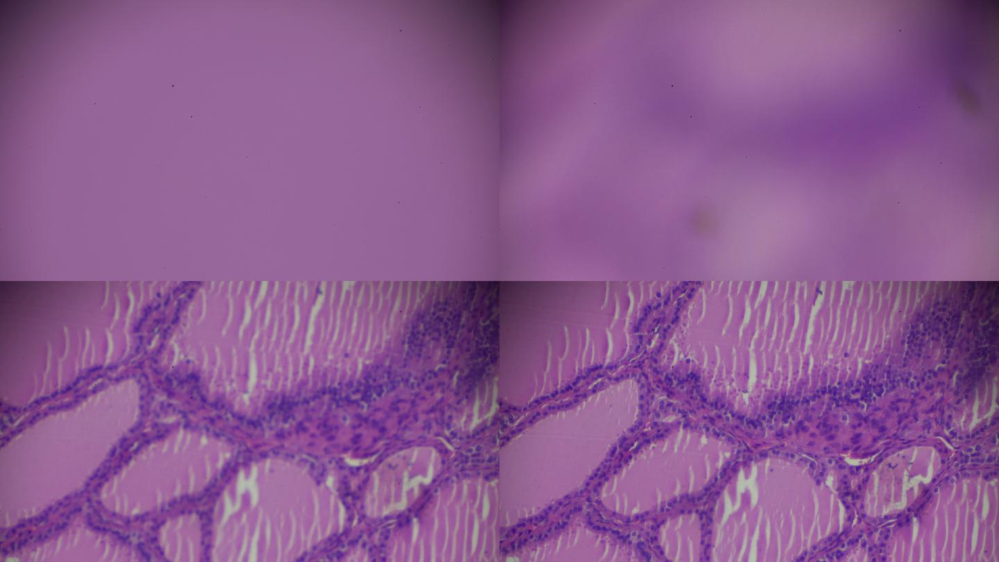 光学显微镜下的毒性甲状腺肿（甲状腺炎）