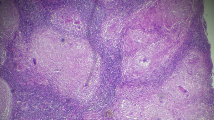 显微镜下淋巴结结核病理标本