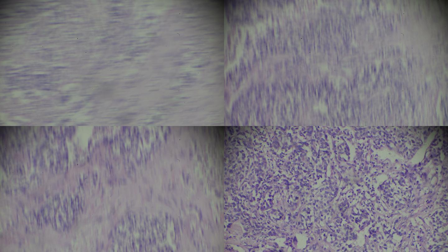 显微镜下膀胱移行细胞癌不同区域的放大