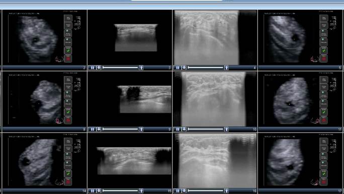 女性乳房X线照片医疗保健和医学肿瘤学医学