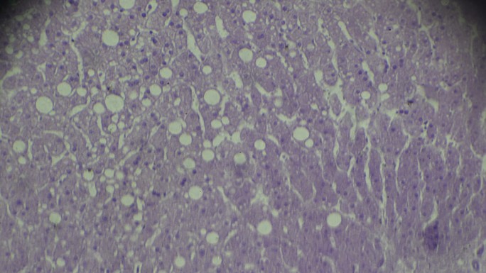 肝脏脂肪变性显微镜下可见圆形脂肪沉积
