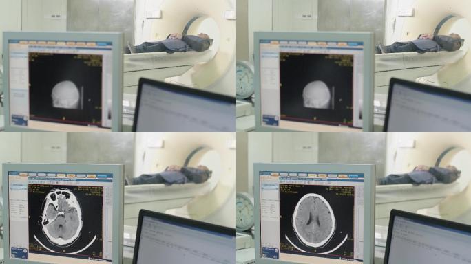 脑CT扫描