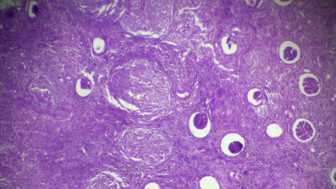 金尼肺结核病理标本显微镜下观察
