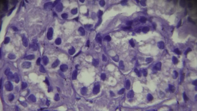 甲状腺癌显微镜活检