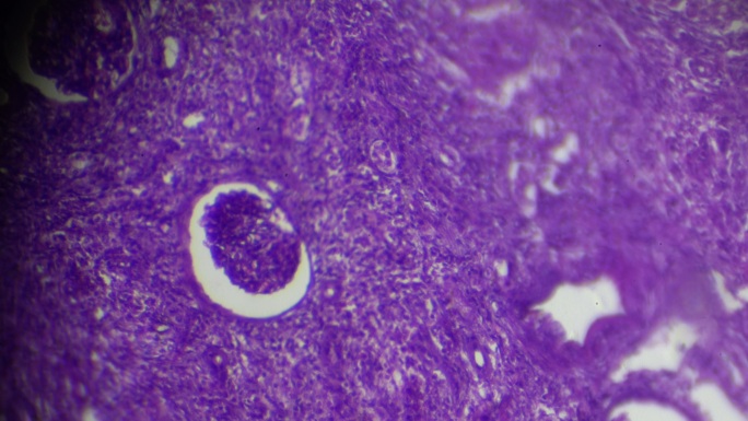 在显微镜下观察金尼肺结核病理标本