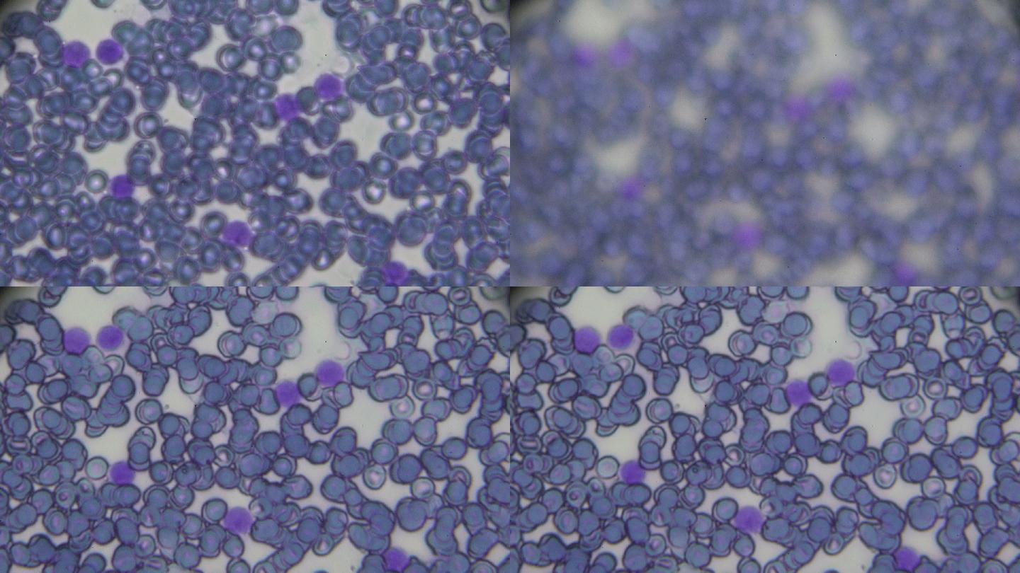 光镜下急性淋巴细胞白血病ALL-L2血涂片