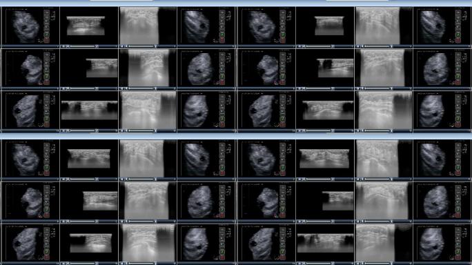 女性乳房X线照片