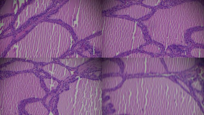 光学显微镜下的毒性甲状腺肿（甲状腺炎）