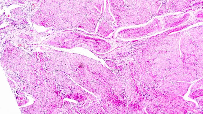 显微镜下子宫内膜癌生物样本在不同范围内放大