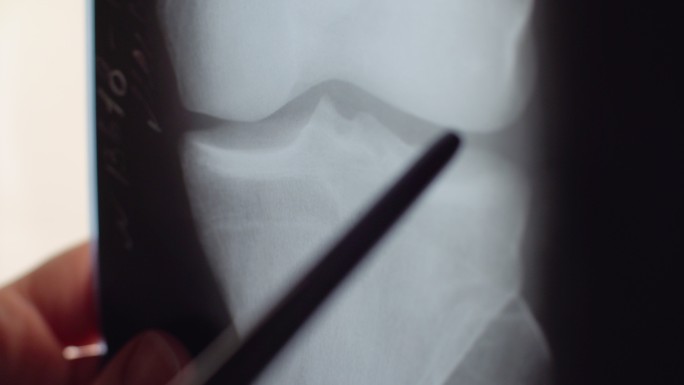 膝关节X线会诊商讨X光片