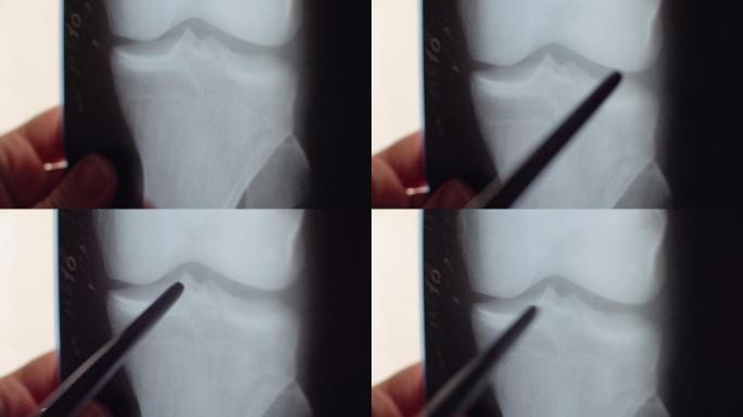 膝关节X线会诊商讨X光片