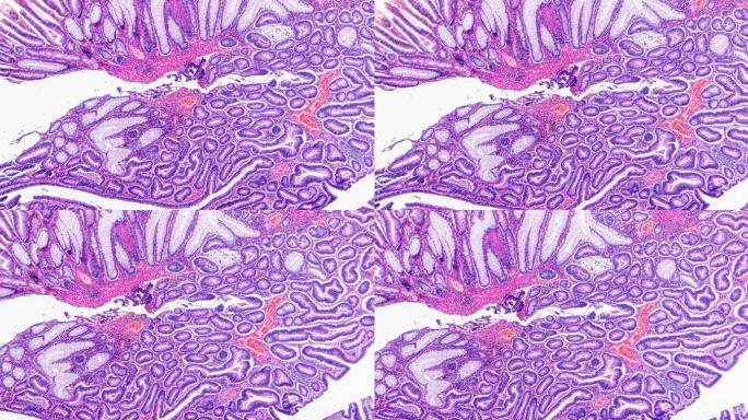 在显微镜下放大不同区域的大肠癌（差异很大的管状腺癌）