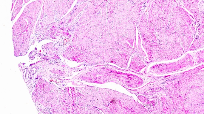 显微镜下子宫内膜癌生物样本在不同范围内放大