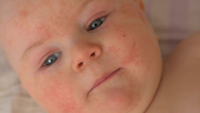 婴儿与过敏儿童皮肤病宝宝皮肤敏感皮肤