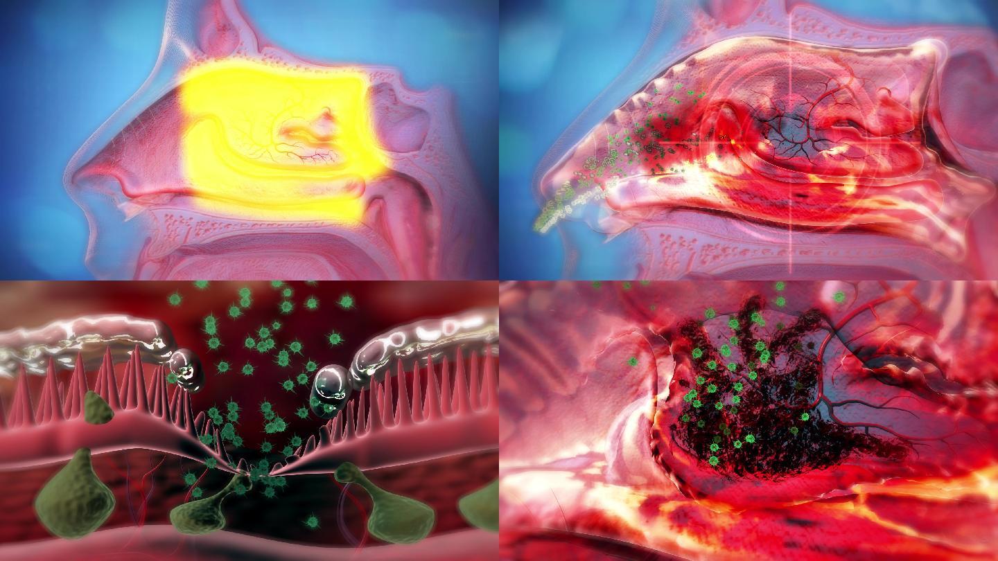 现代医学证实:鼻子分为外鼻腔和内鼻腔,鼻炎就是内鼻腔的鼻黏膜被细菌
