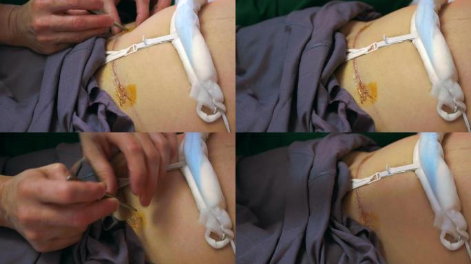 剖宫产术后手术缝线外科手术外科医生