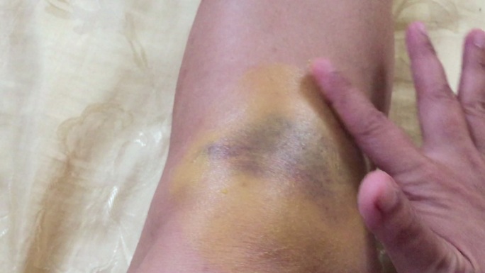一名妇女在膝盖上受伤的大血肿瘀伤上涂抹治疗性软膏止痛凝胶