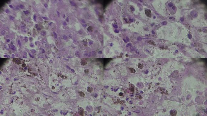 显微镜下黑色素瘤活检不同区域的放大