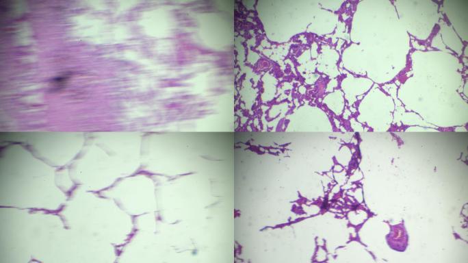 显微镜下肺气肿人体病理标本