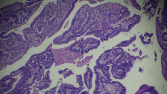 显微镜下的大肠癌（高度分化的管状腺癌）