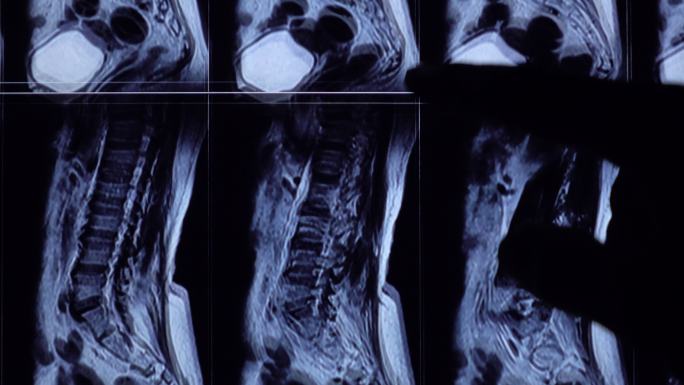 腰椎MRI平板检查