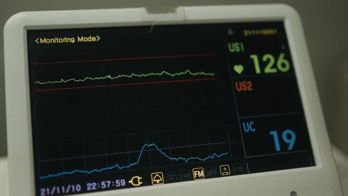 视频心血管内科ICU监护仪与医院患者生命体征