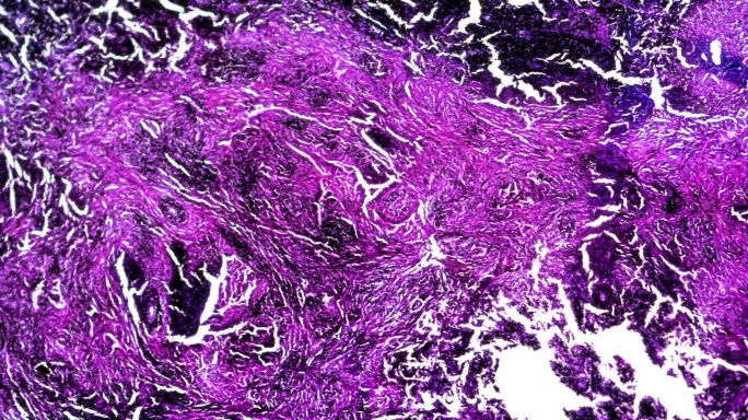 矽肺黑沉淀物显微镜下人体病理生物标本
