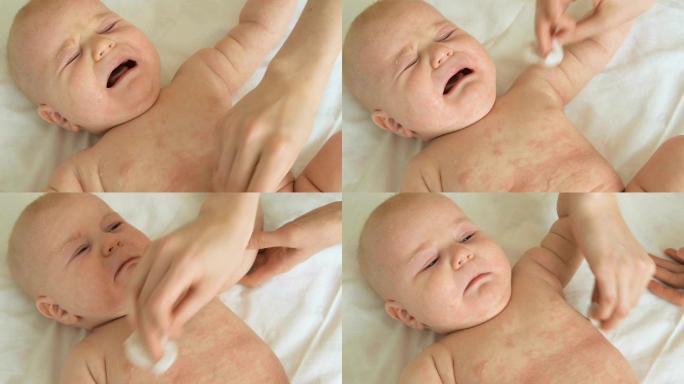 满身皮疹的婴儿新生儿生育哺乳期
