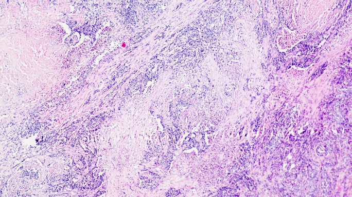 膀胱移行细胞癌显微镜下不同区域放大