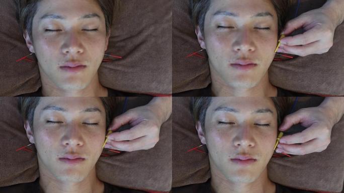 亚洲男性面部美容针灸