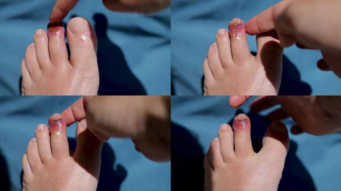 男子将药膏涂抹在肿胀和擦伤的脚趾上