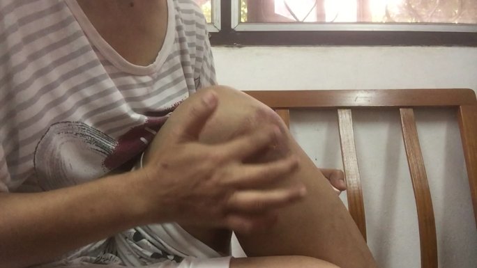 一位女性在膝盖上的大面积血肿瘀伤中使用治疗性软膏止痛凝胶