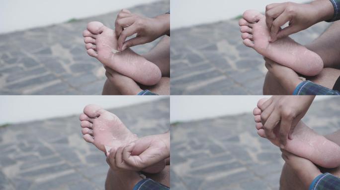 特写：一名男子剥下右脚皮肤