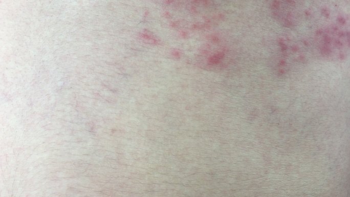 带状疱疹（带状疱疹）皮疹，皮肤上有水疱。特写镜头。