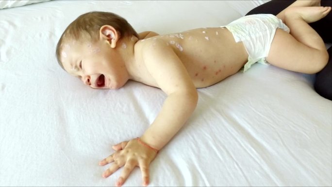 母亲照顾水痘婴儿在家给婴儿小孩涂药生病的