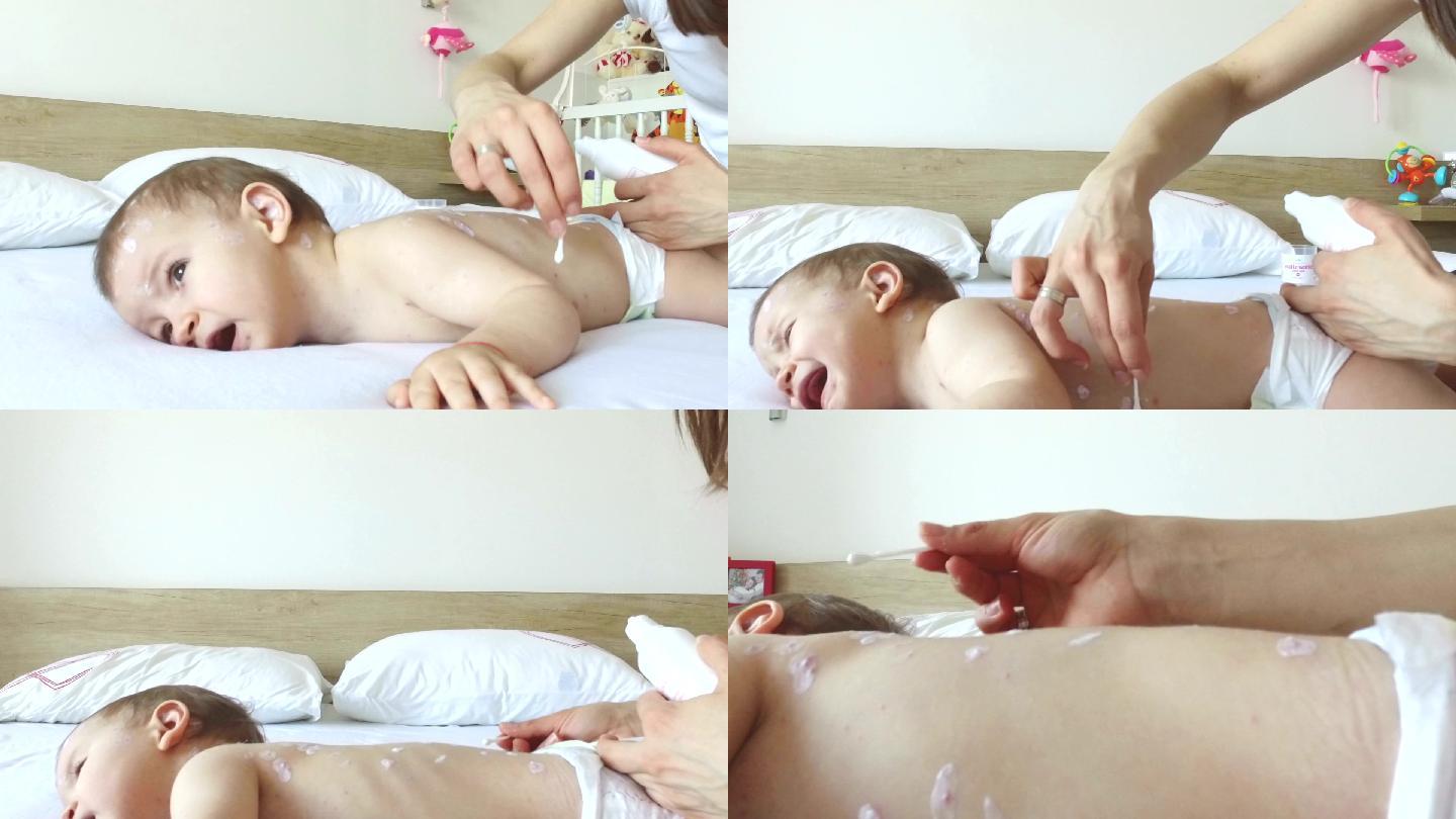 母亲照顾水痘婴儿涂抹药物小孩子挣扎