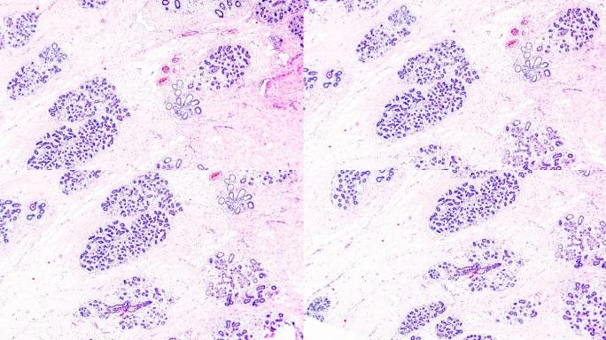 光学显微镜下乳腺癌不同区域的放大
