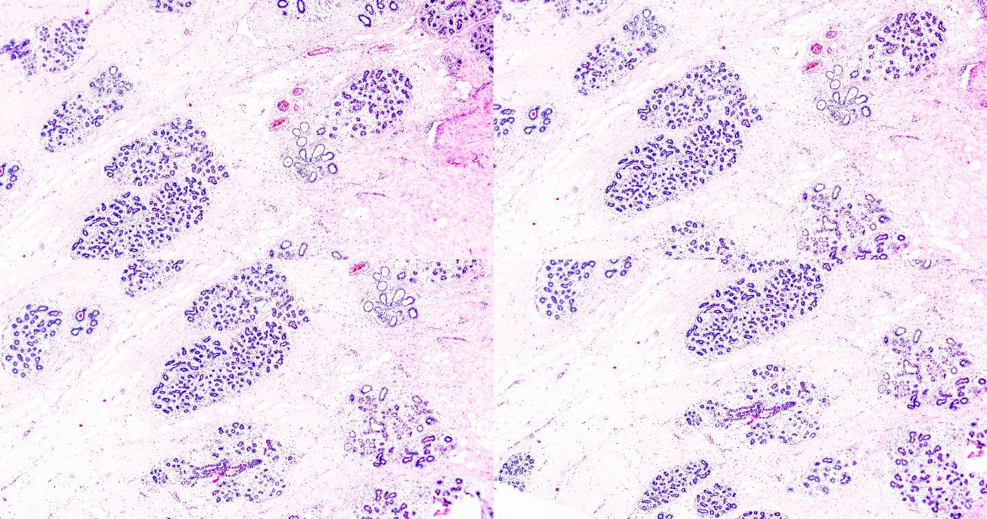 光学显微镜下乳腺癌不同区域的放大