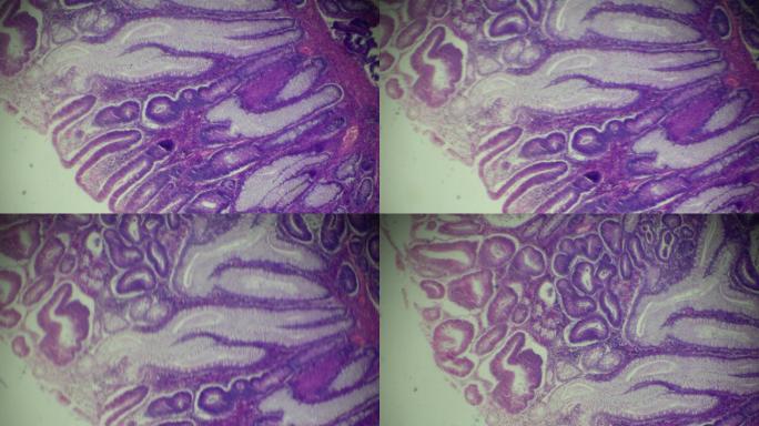 显微镜下的大肠癌（高度分化的管状腺癌）