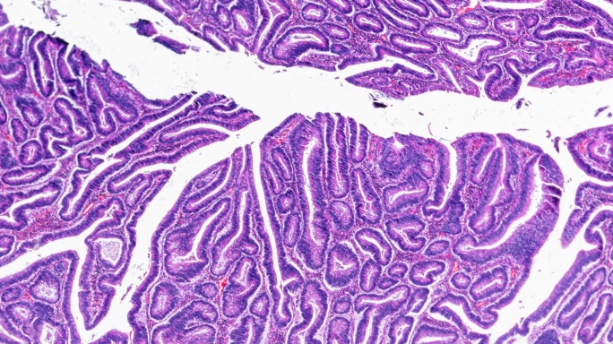 显微镜下放大不同区域的大肠癌（高度分化的管状腺癌）