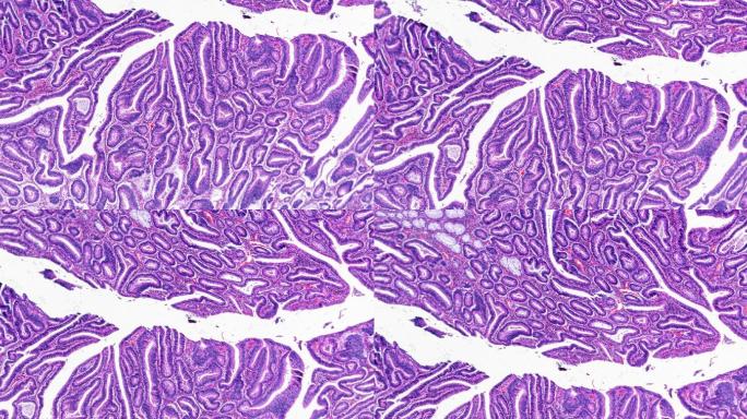 显微镜下放大不同区域的大肠癌（高度分化的管状腺癌）