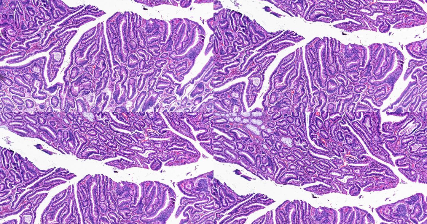 显微镜下放大不同区域的大肠癌（高度分化的管状腺癌）