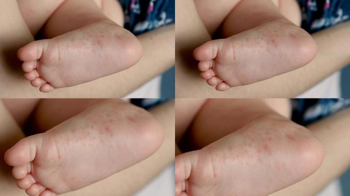 婴儿足有过敏症状宝宝过敏红痘疱疹