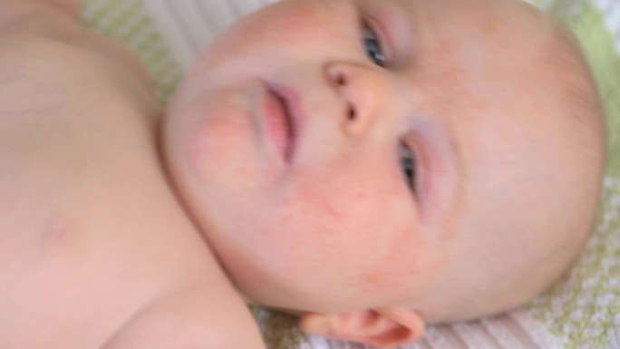 婴儿与过敏小孩身体过敏红疹皮肤