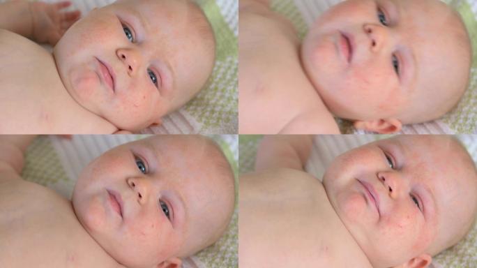 婴儿与过敏小孩身体过敏红疹皮肤