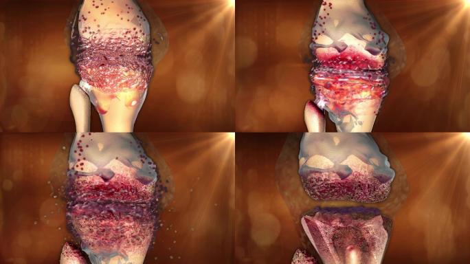 关节滑膜软骨被破坏骨组织暴露酸毒液被腐蚀