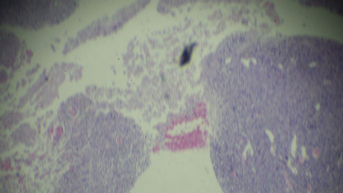 睾丸生殖细胞瘤的光镜观察